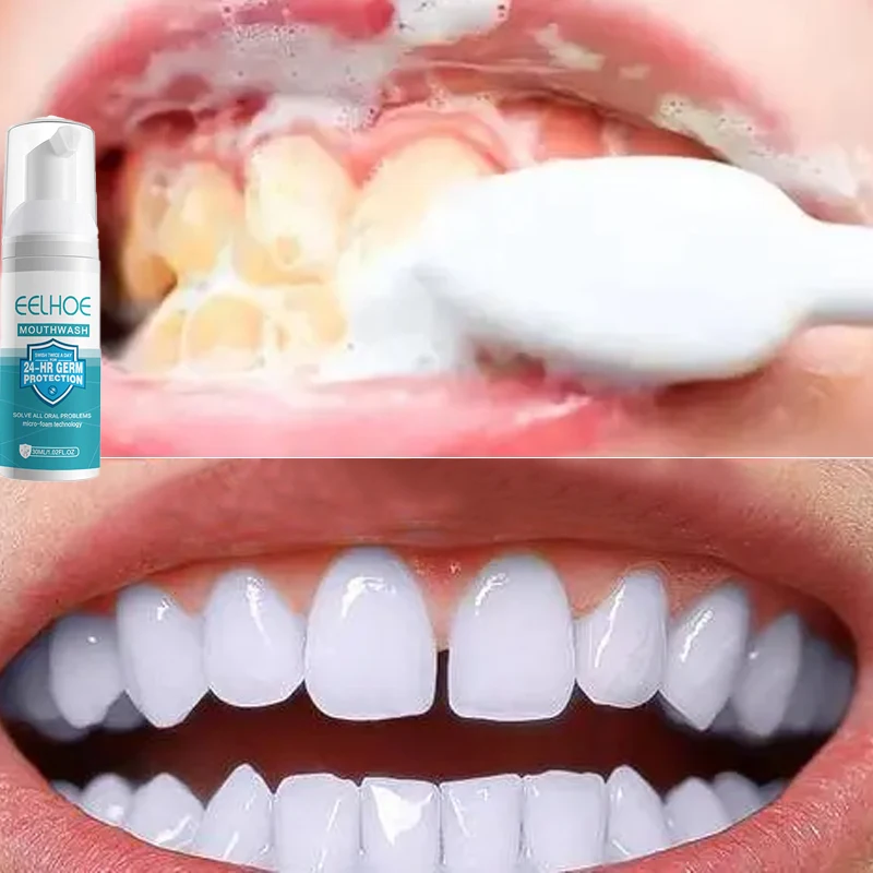 

Tooth Stain Removal Gum Bleeding Whitening Deep Cleaning Dental Plaque Oral Hygiene Products