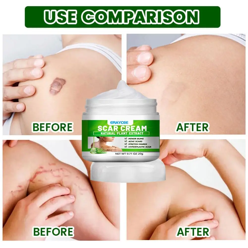 

20g Aloe Scar Removal Cream Acne Scar Spot Removal Repair Cream Blemish Cream Skin Gel Face Burn Care Treatment K8U5
