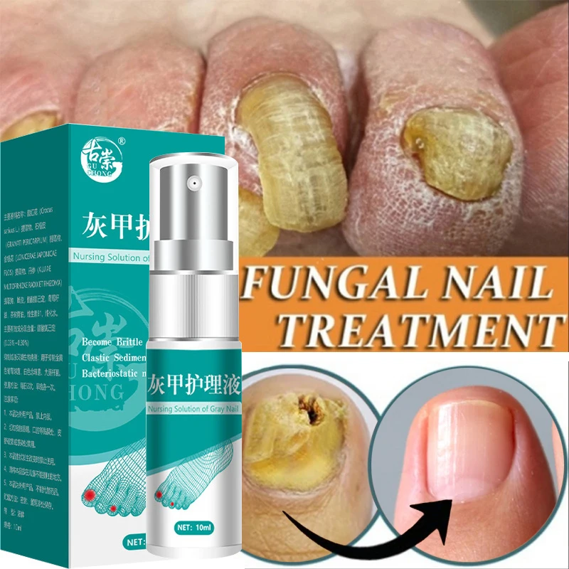 

Nail Fungus Treatments Serum Spray Repair Toe Nail Fungal Removal Essence Anti-Infection Onychomycosis Paronychia Nail Care 10ML