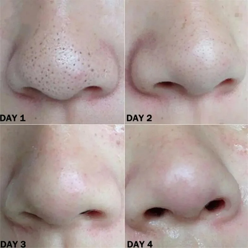 10 PCS Nose Blackhead Remover Mask Deep Cleansing Skin Care Shrink Pore Acne Treatment Black dots Clean Strips |