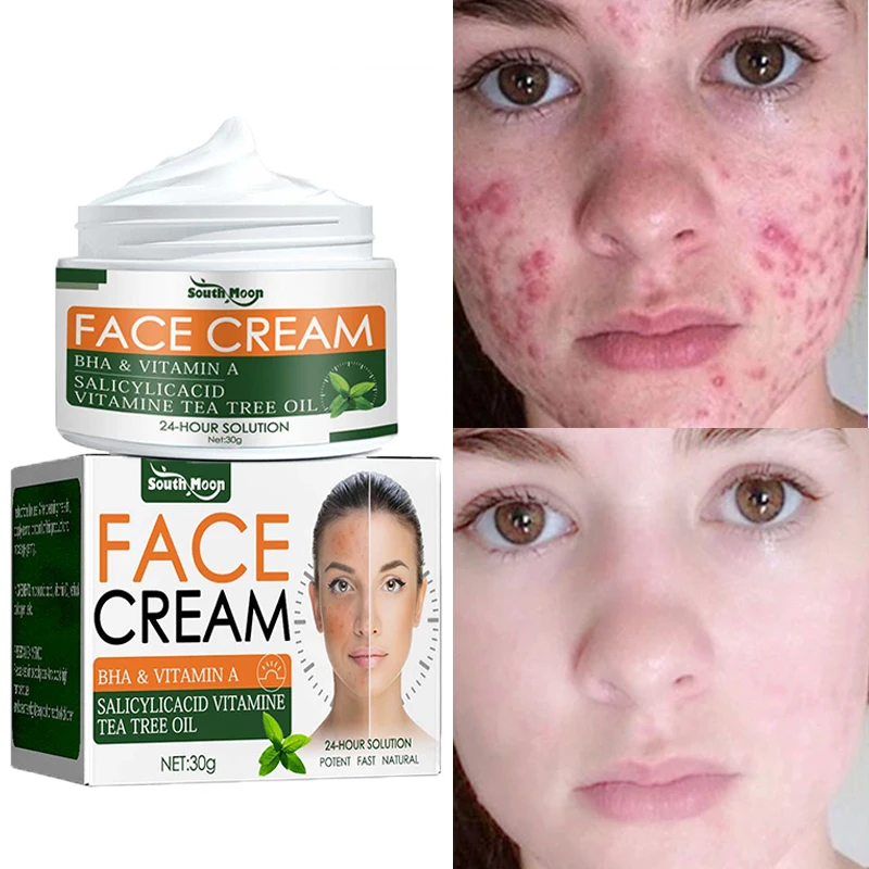 Effective Removal Acne Cream Acne Treatment Pimple Scar Repair Shrink Pore Oil Control Moisturizing Gel Whitening Face Skin Care