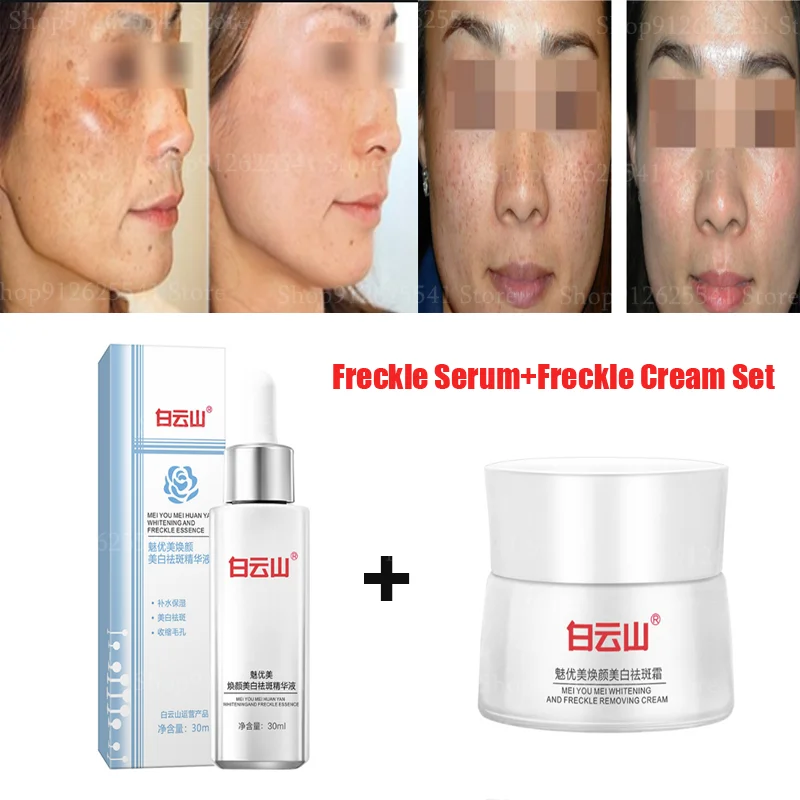 

2Pcs Whitening Freckle Cream Serum Set Remove Dark Spots Anti Freckle Cream Fade Pigmentation Melasma Brighten Skin Care