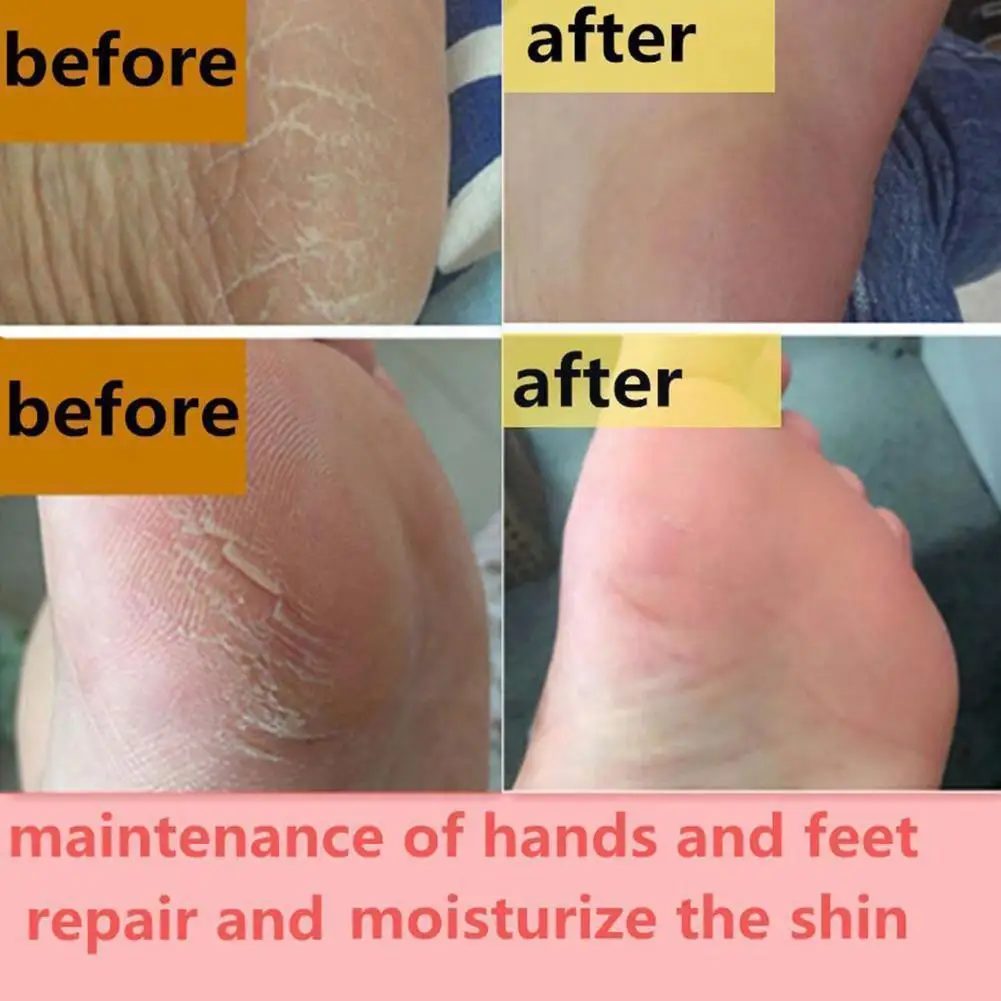 

Anti-drying Heel Cracked Repair Cream Chinese Hand Feet Care Foot Herbs Skin Cream Cream Removal Dead Hand Crack M4g9