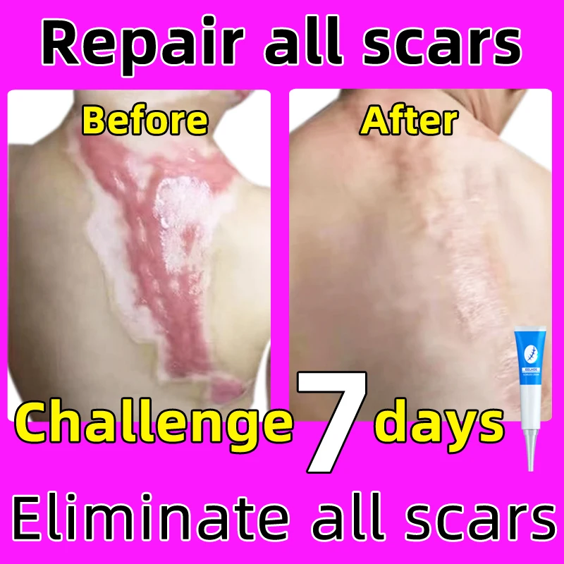Effective scar repair gel for the treatment of various scars hyperplasia surgery cesarean section stretch marks burn scars