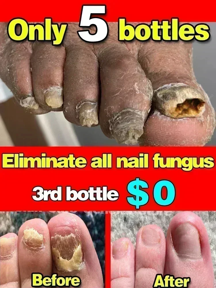 Новое лечение грибка ногтей для силового восстановления на ногах увлажняет