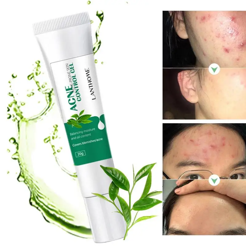

Pimple Gel Blackhead Popper Blemish Gel To Repair Pimple Marks And Moisturize Skin For Enlarged Pores Oily Skin Whitehead