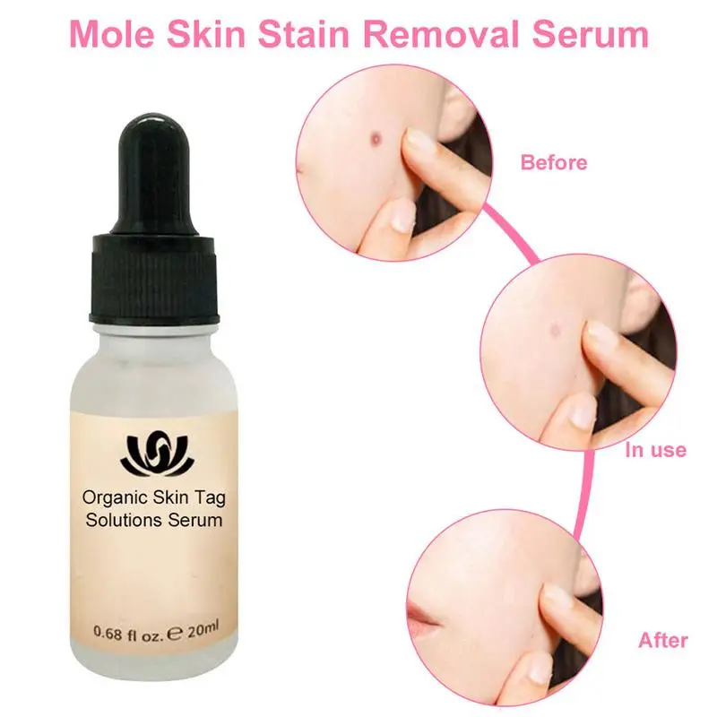 

Organic Tags Remover Serum Solutions 20ml X PCs Painless Skin Mole Dark Spot Stain Corrector Essence Facial Care Fluid For Girl