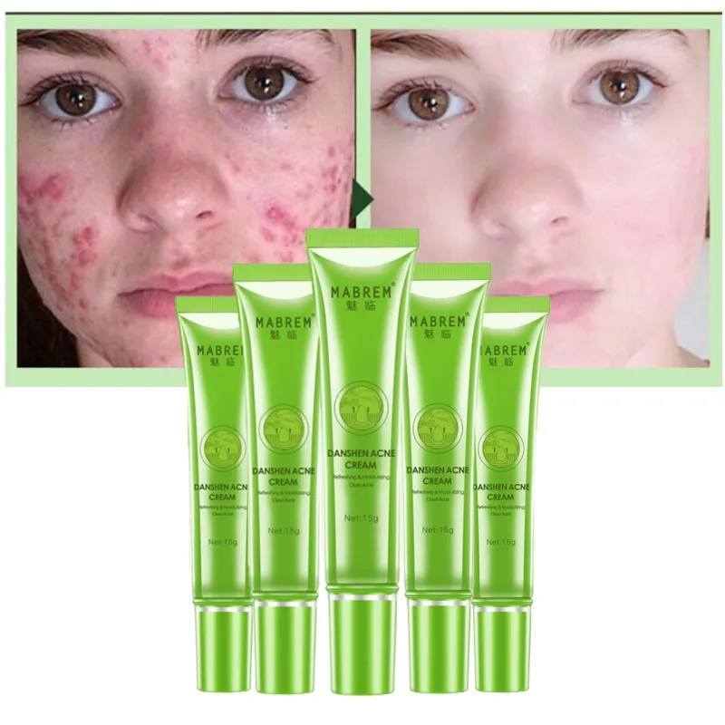 

5PCS Acne Removal Cream Effective Anti-Acne Treatment Gel Shrink Pores Improve Acne Scar Spots Whitening Moisturizing Skin Care