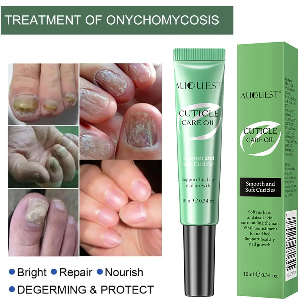 

Средство для ухода за ногтями, Жидкость против инфекции, онихомикоз, паронихия, сыворотка для рук, ногтей, восстанавливающий грибковый раствор, средства для удаления