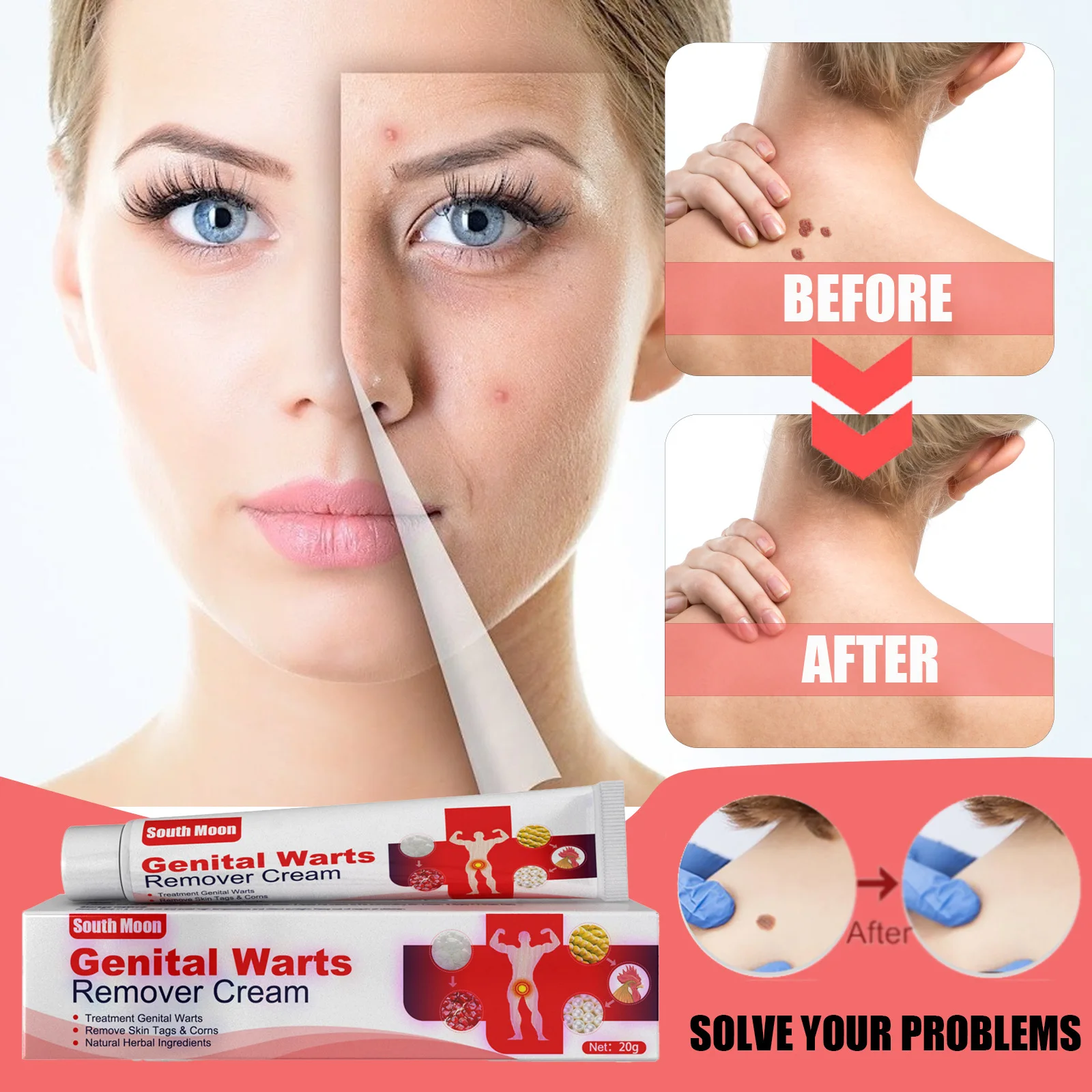 

South Moon Warts Removal Herbal Cream Hand Foot Face Armpit Meat Granules Corn Remove Ointment Filiform Stabilize Verrucous Skin