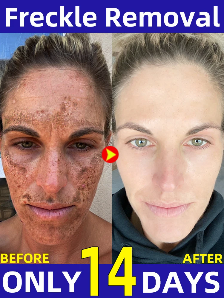 Прозрачная хлоазма солнце темный возраст веснушки