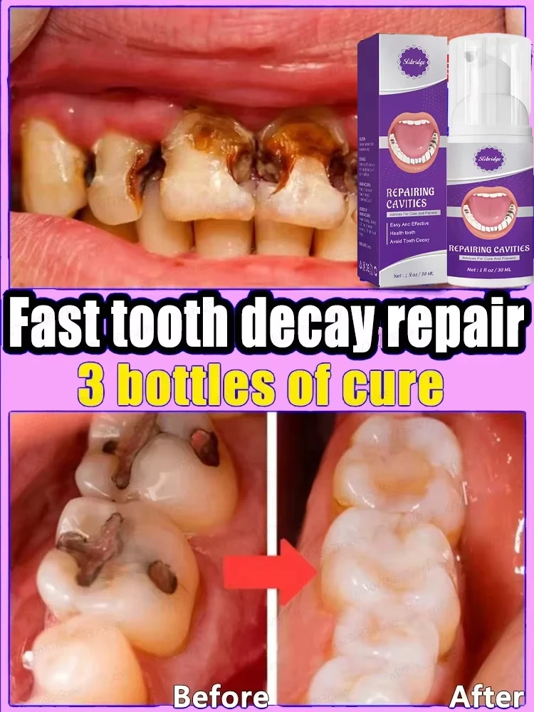 Зубный карь ремонт полостей защита от кариеса