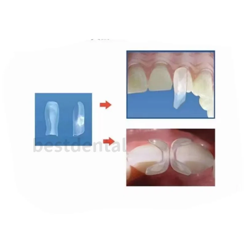 Стоматологическая прозрачная матрица восстановление переднего и заднего вида BT
