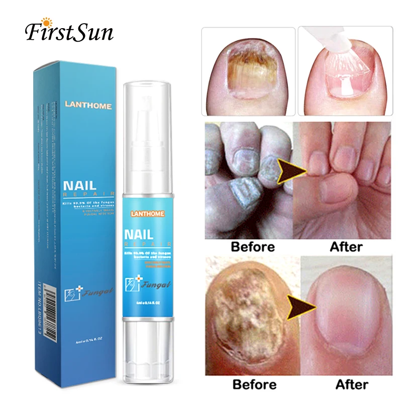 

Anti Toe Nail Fungal Treatment Herbal Toenail Fungus Athletes Foot Fungi Nail Cream Nail Growth Products Manicure Nails Oil Pen