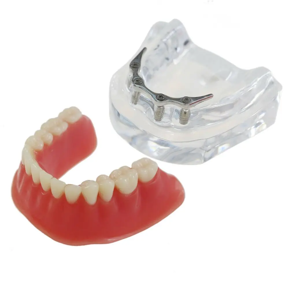 

Демонстрация зубов, имплантаты, модель зубов, съемный Overdenture M6008