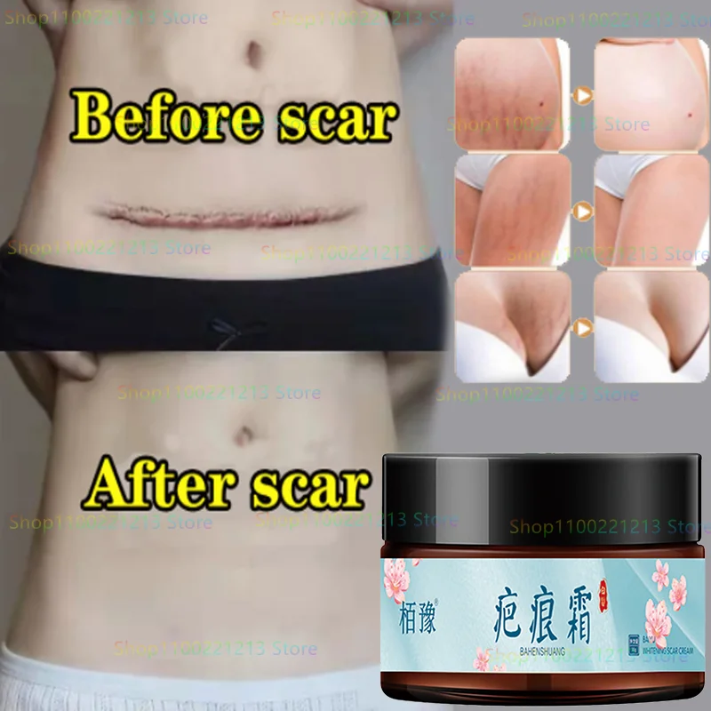 

Scar Cream Stretch Mark Repair Traceless Repair Cream Burns Scalding C-section Acne Mark Repair Gel Whitening Cream Body Cream