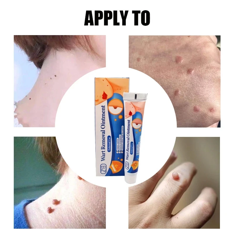 1/3 шт. антибактериальная мазь для удаления бородавок |