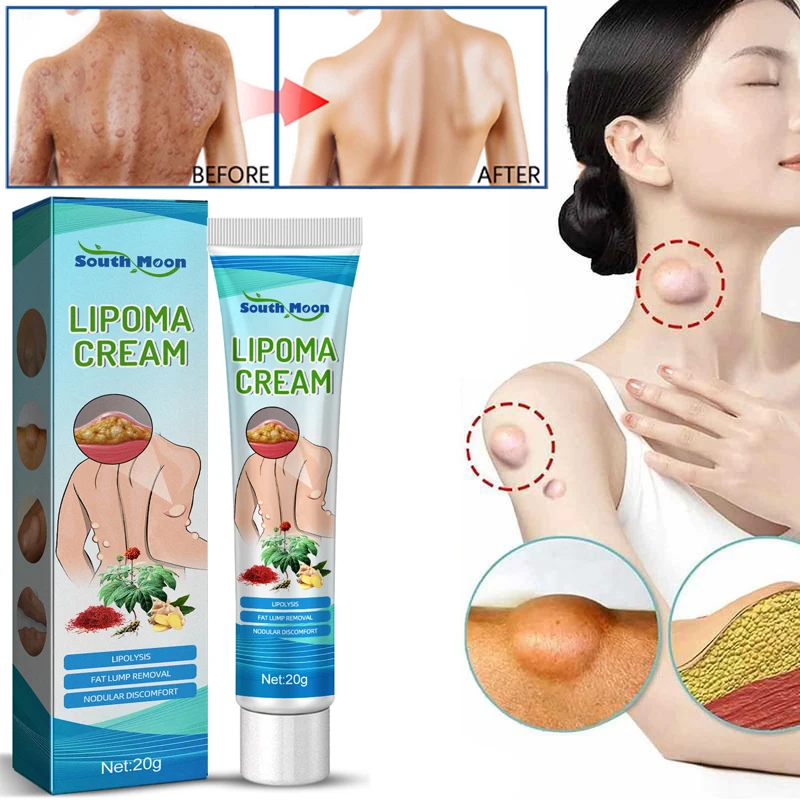 

Крем Lipoma для снятия симптомов воспаления, лечение опухолей, цист, отек, нодулярное облегчение боли, отшелушивание, уход за телом 20 г