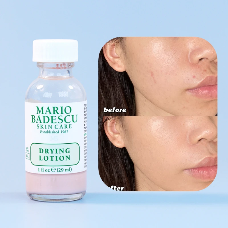 

29ml An Effective Acne Treatment Original Mario Badescu Drying Lotion Anti Acne Serum Pimple Blemish Removal Skin Care