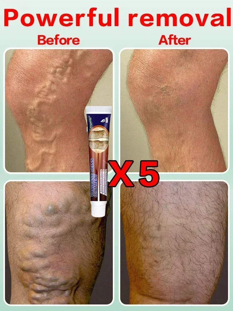 Фотоаппарат для лечения варикозного ангиита удаления отеков и боли в бедре