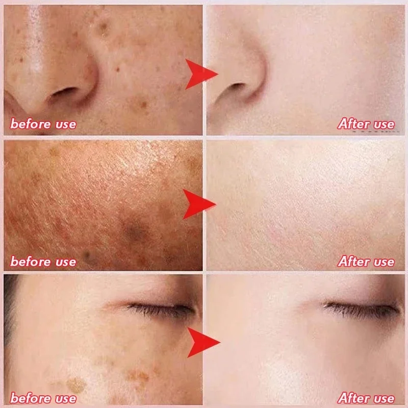 Флюоресцентный крем для лица средство удаления темных точек восстановление