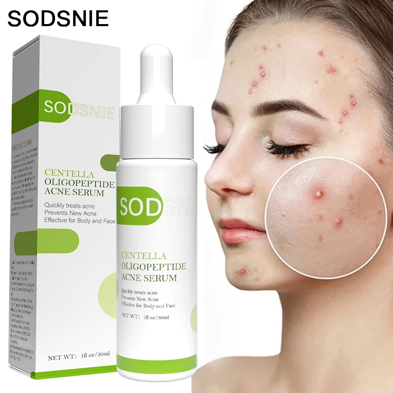 

Acne Serum Moisturizing Oil Control Deep Nourishment Powerful Repair Eliminate Inflammation Remove Acne Scars Blackheads 30ml