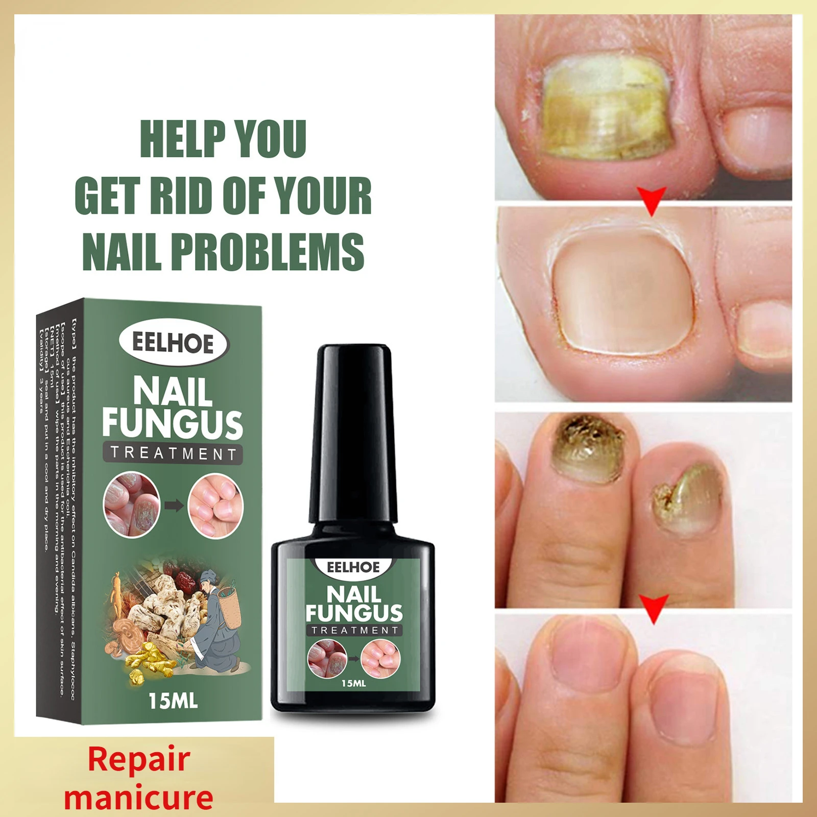 

Hand and Foot Onychomycosis Care Repair Anti-bacterial Onychomycosis Liquid Thickened Soft Nail Onychomycosis Liquid NailFungus