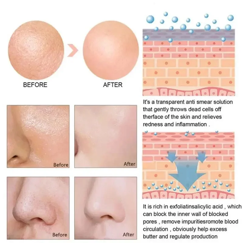 Удаление большого поры Сыворотка с молочной кислотой сужение пор на лице