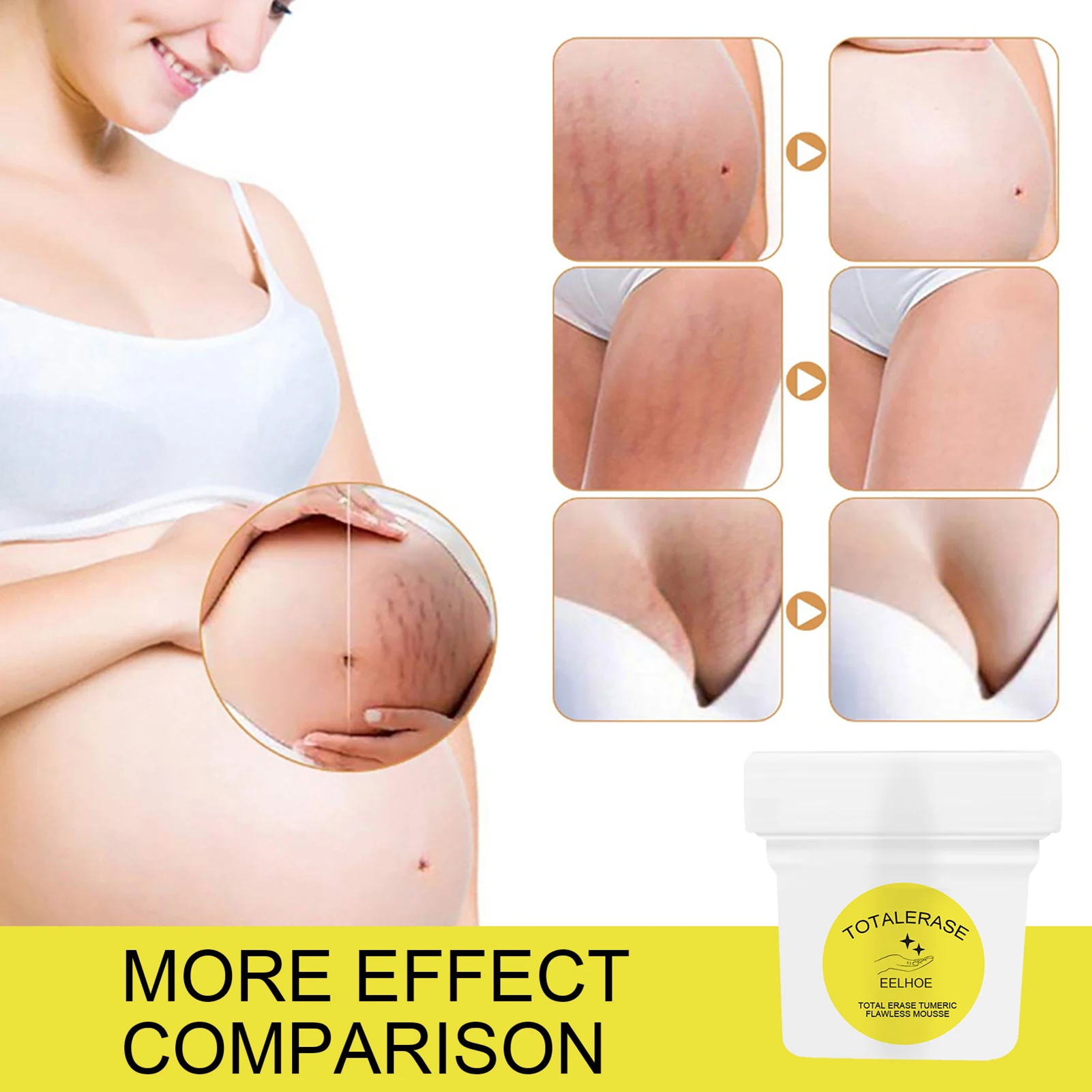 

Stretch Mark Cream Repair Scar Slack Line Abdomen Stretch Marks Cream Stretch Mark Remover And Scar Remove Stretch
