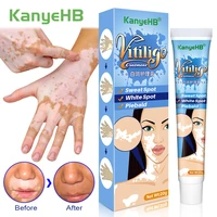 20g herbal extract vitiligo ointment remove ringworm white spot removal skin white spot leukoplakia disease treatment cream