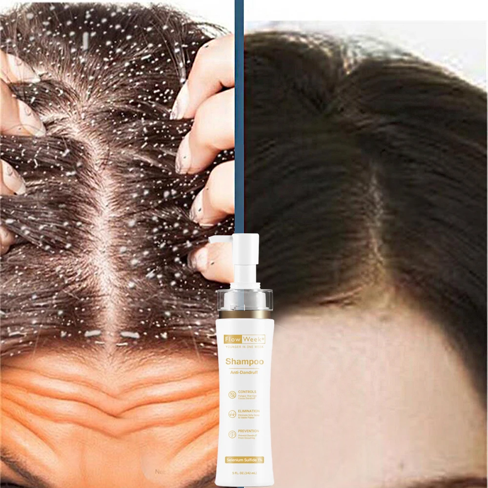 

FlowWeek Remove Dandruff Anti Itching Shampoo Treatment Seborrheic Scalp Oil Control Cleansing Scal Antibacterial Mite Hair Care