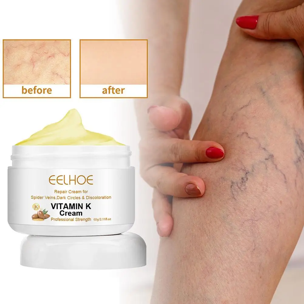 

Professional Varicose Veins Cream Effective Relieve Leg Vasculitis Phlebitis Spider Pain Swelling Care Products