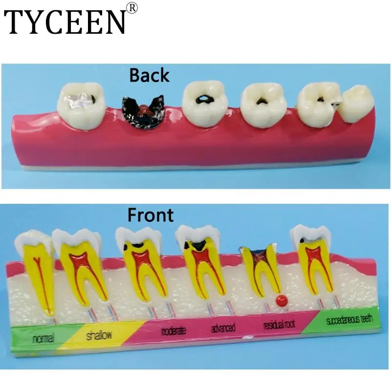 

Dental Caries Classify Model Tooth Model Demonstration Teach Study Dentist Teeth Caries Evolution Decayed Tooth Analysis Model