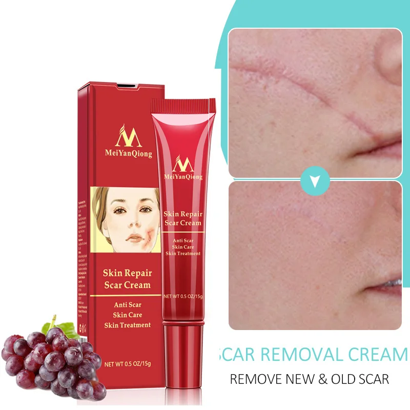 

Эффективный крем для удаления шрамов от акне, восстанавливающий кожу телефон, стрейч-Mark, хирургическое лечение шрамов, отбеливающий уход за...