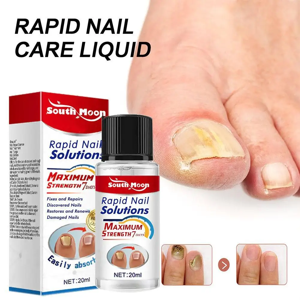 Nail Fungus Treatments Serum 20ml Foot Care Serum Toe Nails Fungal Removal Gel Anti-Infection Toe Fungus Hand Foot Onychomycosis