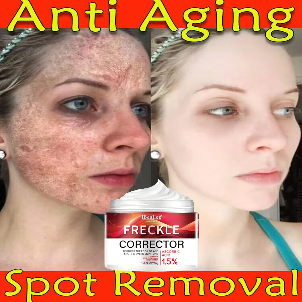 

iBeaLee Whitening Freckles Cream Remove Melasma Dark Spots Lighten Melanin Fade Acne Scars Anti-Aging Brighten Face Skin Care