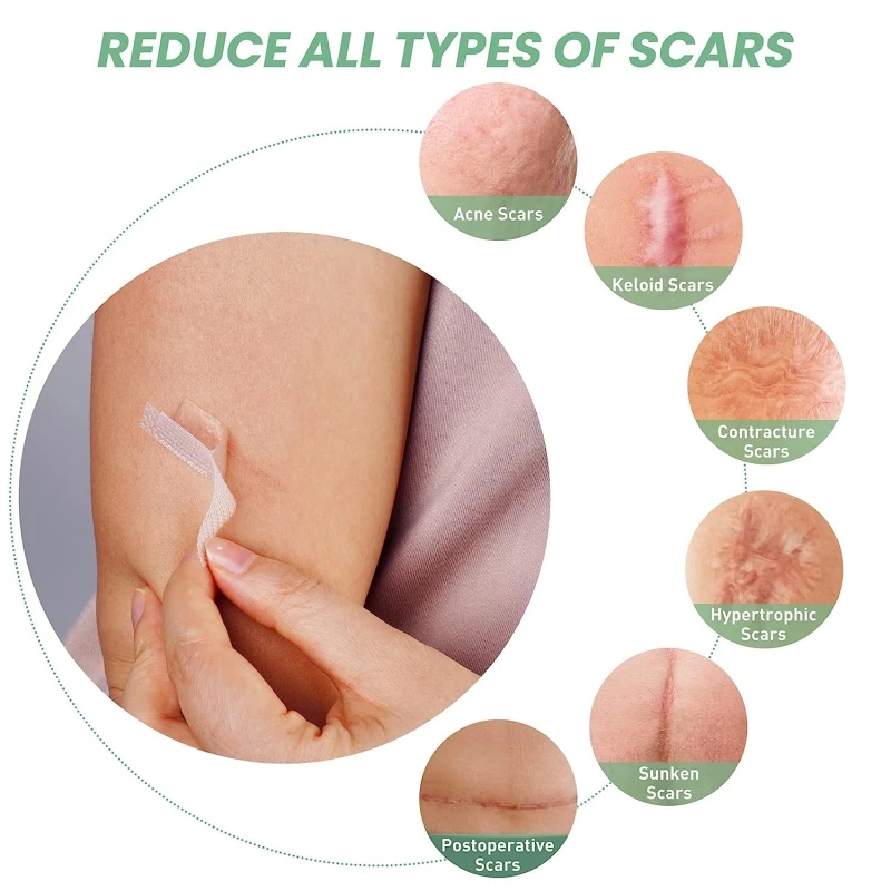 Mebak Прозрачный Силиконовый Лист Для Шрамов Безболезненная Ремонтная Лента