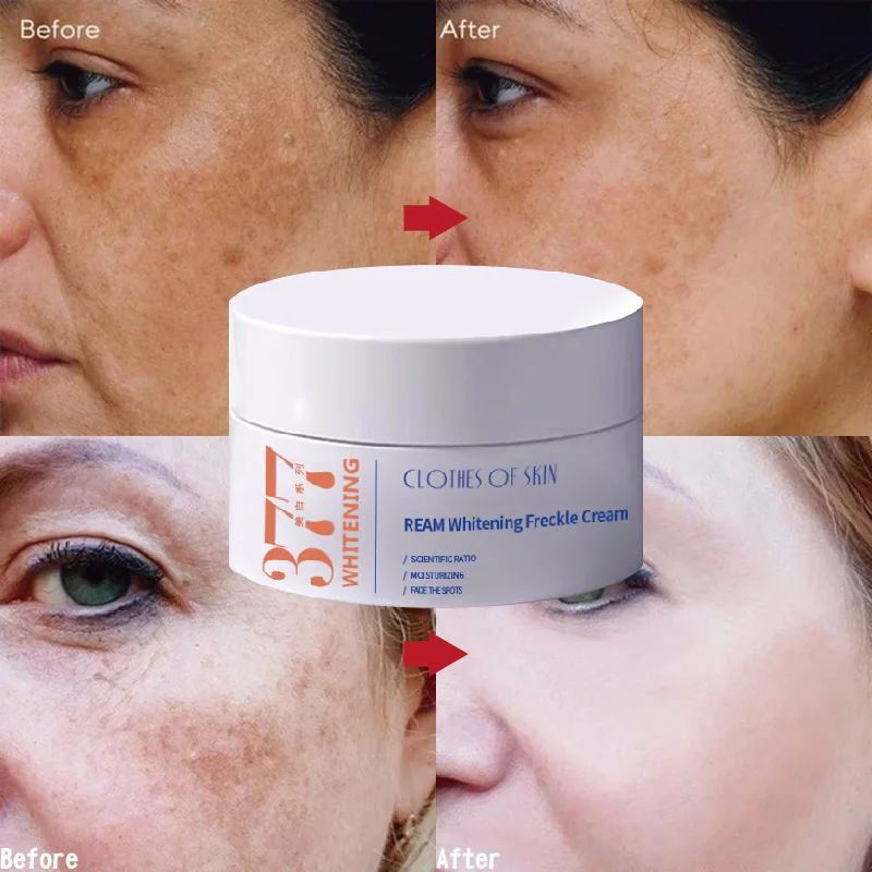 

Whitening Freckle Remove Cream Face Remove Dark Spots Fade Melanin Cream Anti-Pigmentation Improve Dullness Brighten Skin Care