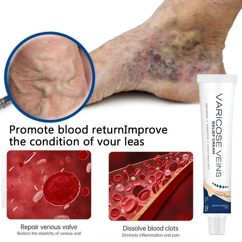 Крем от варикозного расширения вен Earthworm-Успокаивающий массажный бальзам для