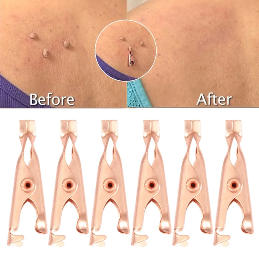 

1/2pcs Wart Remover Small Clip Copper Skin Tag Removal Cleaning Kit Facial Neck Body Warts Treatment Clips Unisex Beauty Tools