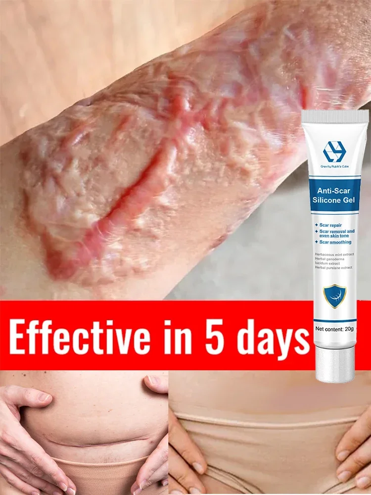 Ремешок для удаления циклозы цезария эстрия циклические круги эскалация зоны