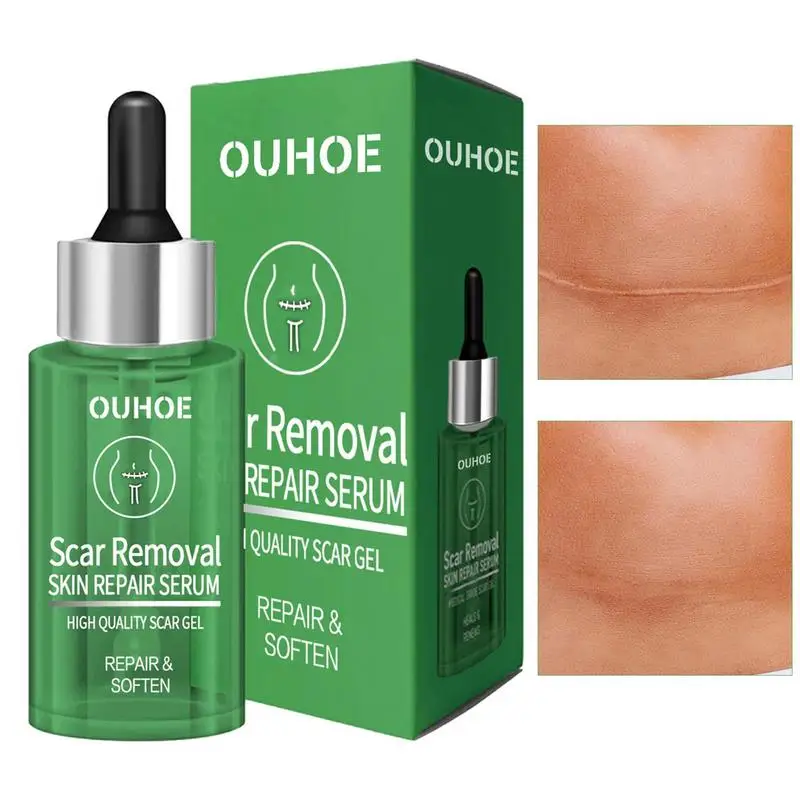 

Scar Repair Essence 30ml Natural Scar Removal Alternative Multi-use Nourishing Scar Shrinking Oil For Keloids Bumps Raised Scars