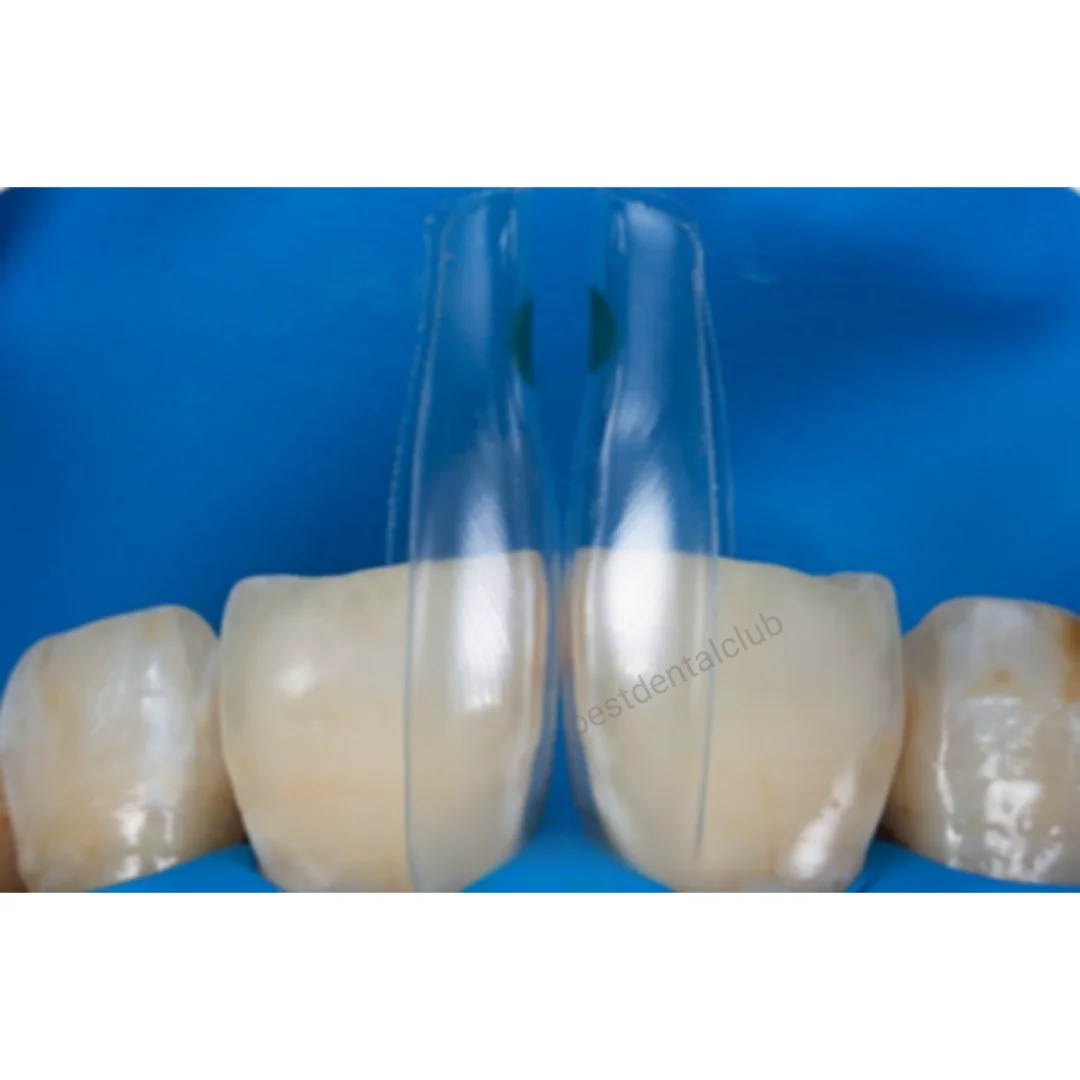 5 шт. прозрачные матрицы Bioclear