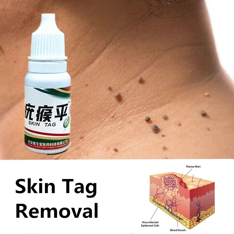 

Really Work Body Warts Corn Mole Genital Wart Treatment Cream Skin Tag Remover Foot Corn Removal Plantar Genital Warts Ointment