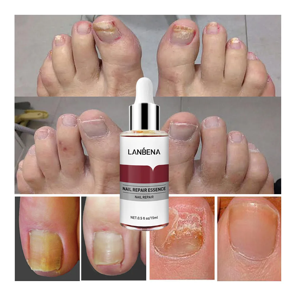 LANBENA Fungal Nail Serum Essence Finger Toe Nail Fungus Removal Gel Anti Infection Paronychia Onychomycosis Treatment Feet Care