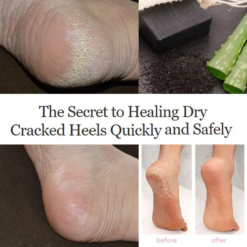 

South Africa Brick Get Rid of Dry Cracked Heels Remove Dead Skin Cells Gain Smooth Soft Baby Feet Citric Acid Gentle Exfoliation