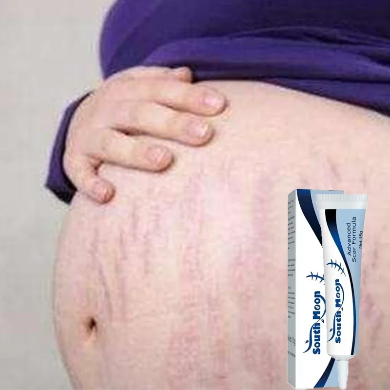 Крем для устранения старых красных и белых линий во время беременности