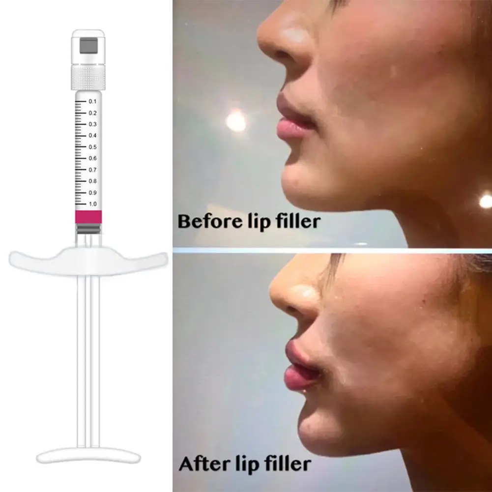 

1/2Ml Molecule Hyaluronic Acid Filler for Face Lips Nose Cheek Shaping Wrinkle Filling Firming Skin Liquid Anti Aging Collagen