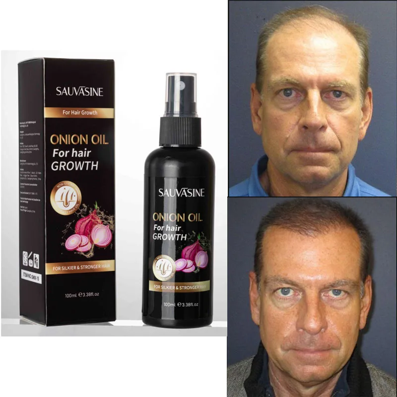 

Onion Oil for Hair Growth Regrowth, Anti Loss Prevent Thinning Dry Frizzy Repair, Damaged Care Treatment 100ml