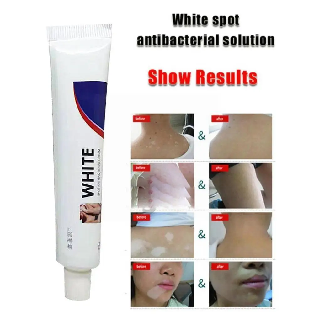 

Chinese Medical Vitiligo Leukoplakia Disease Treatment White Pigment Disease Cream Care Ointment Skin Spot Melanin H6e4